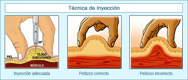 técnicas de inyección de la insulina